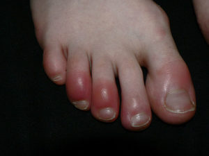 Frostbitten Toes